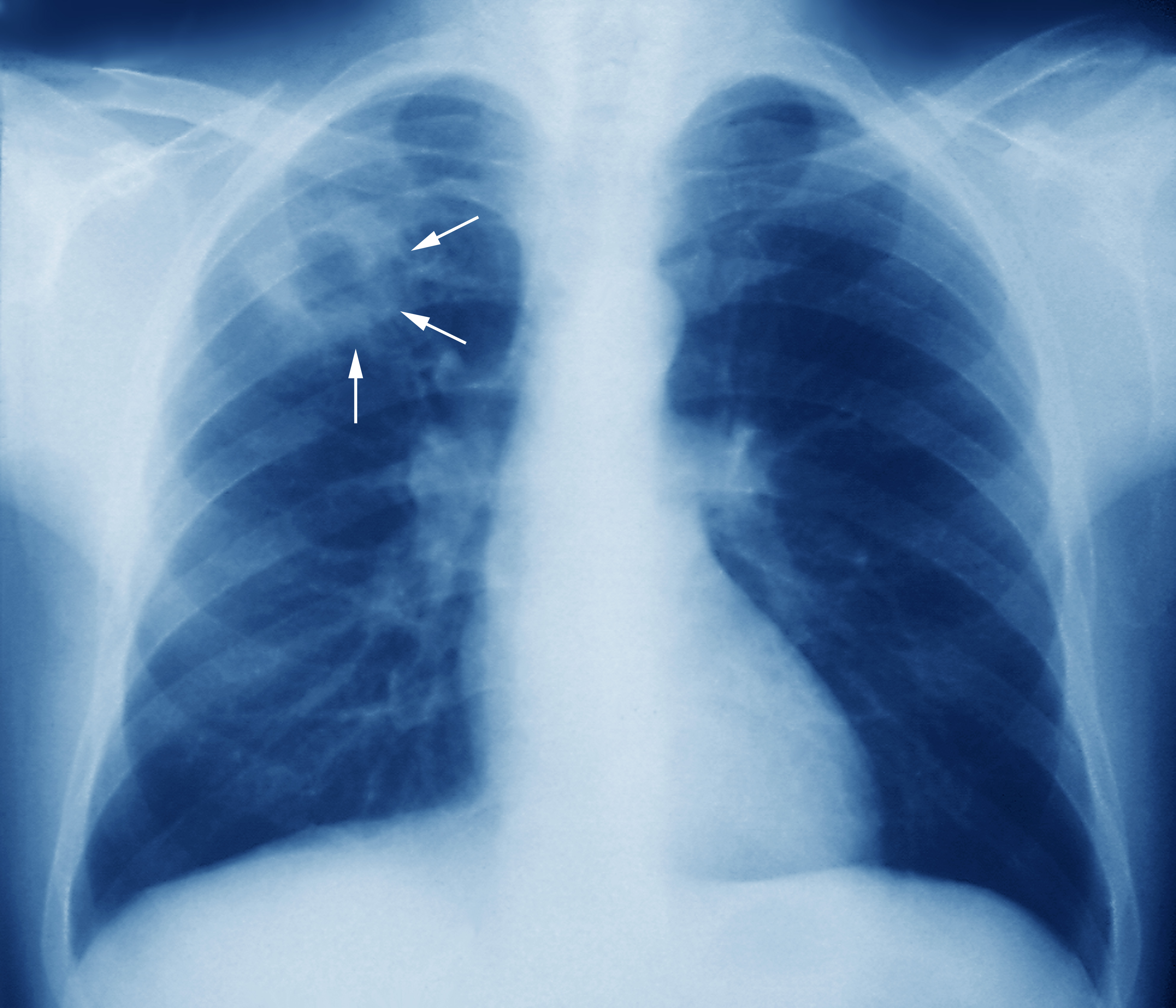 http://terveytta.net/wp-content/uploads/2020/12/m2700245-tuberculosis-chest-x-ray-science-photo-library-high.jpg