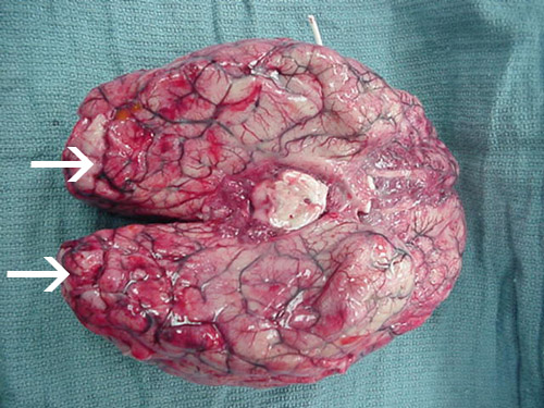 Laaja verenvuoto ja nekroosi esiintyy aivoissa, lähinnä etupuolen aivokuoressa.