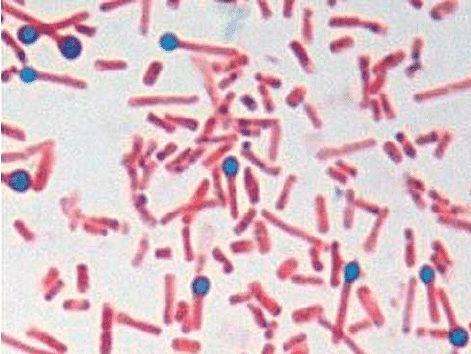 a.  Clostridium tetanin itiöt ja bakteerit tyypillisellä rummun kepin muodolla, joka on eristetty kuorevien haavojen kuoresta tapauksessa 1 (gramma-värjäys-1000x). 