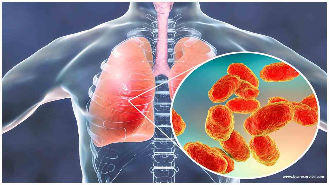 Bakteeri-keuhkokuume: oireet ja hoito