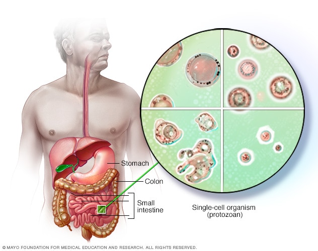 Blastocystis hominis - syyt, oireet ja hoito