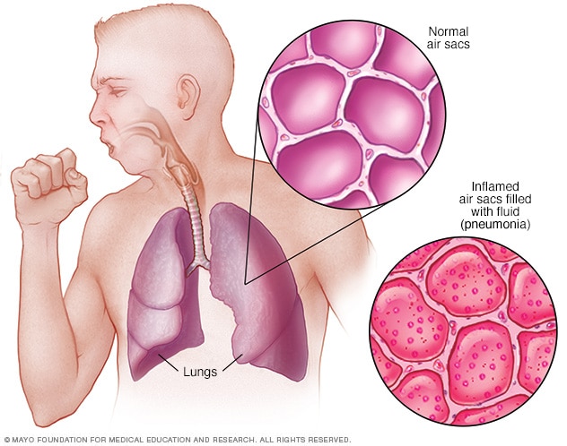 Keuhkokuume: syyt, oireet ja hoito